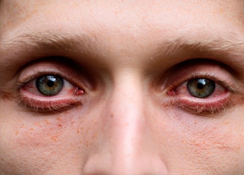 Суженные зрачки